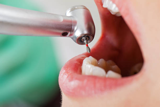Best Emergency Root Canal Treatment in Henry, IL